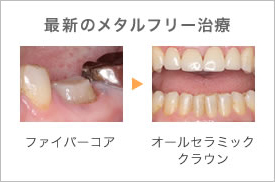 最新のメタルフリー治療