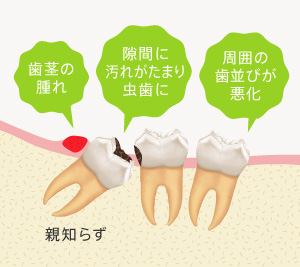 親知らずにより「歯茎の腫れ」「隙間に汚れがたまり虫歯に」「周囲の歯並びが悪化」が引き起こされます