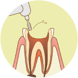 精密根管治療